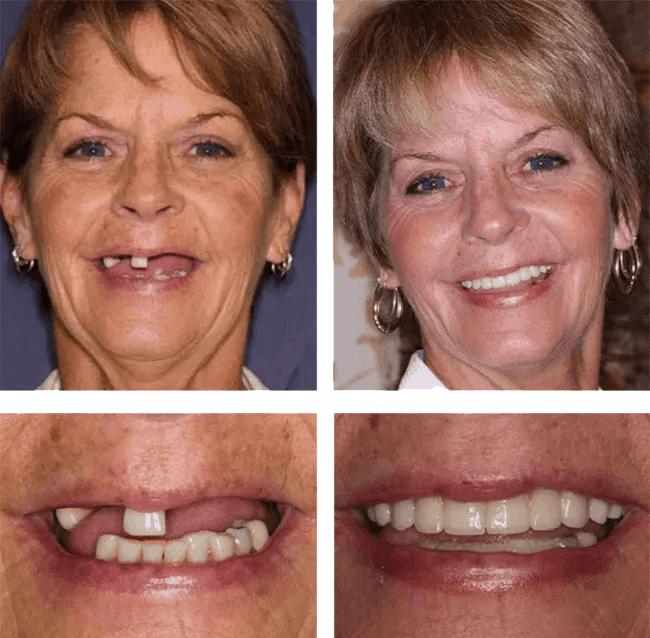 Denise before after image