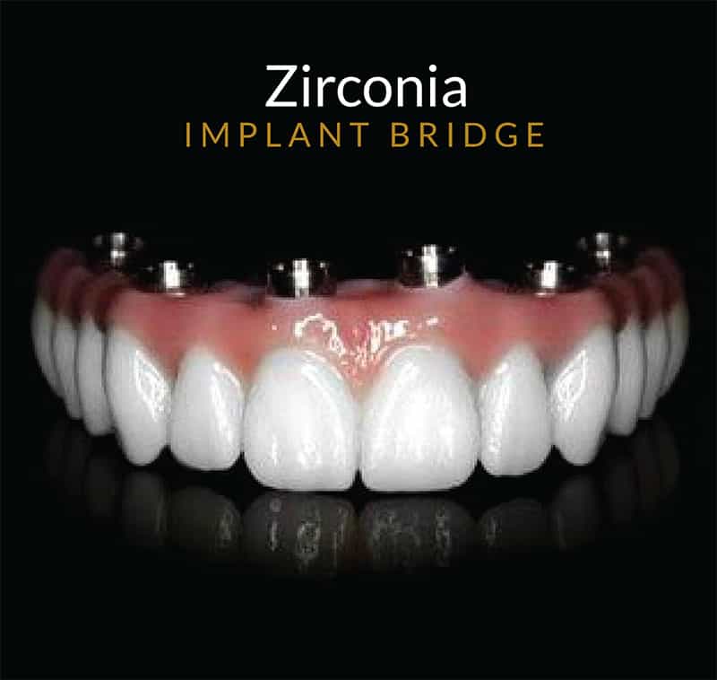 zirconia implant bridge