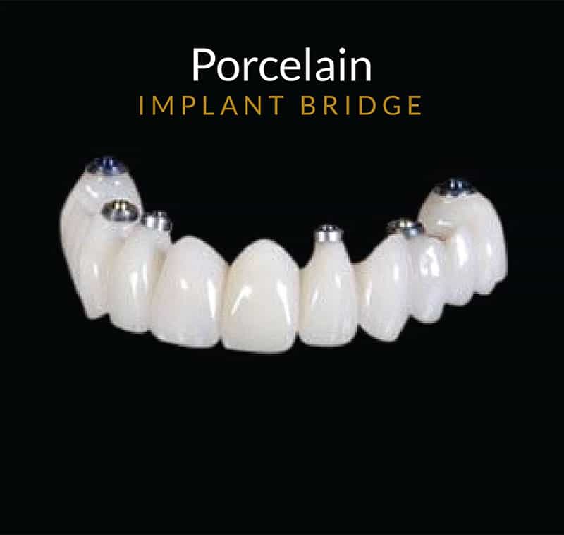 porcelain implant bridge