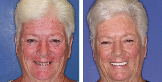 restoring smiles at teeth next day