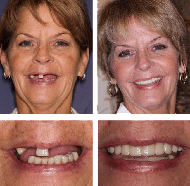 Denise's before after image