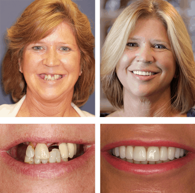 Michelle's before after image