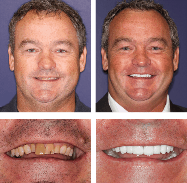 Tim's before after image