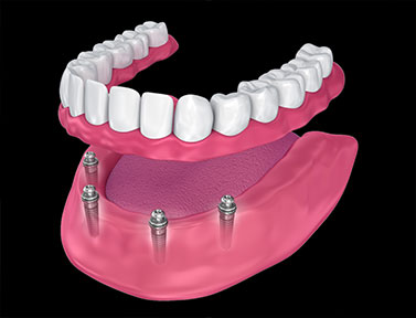 4 Implant Overdenture